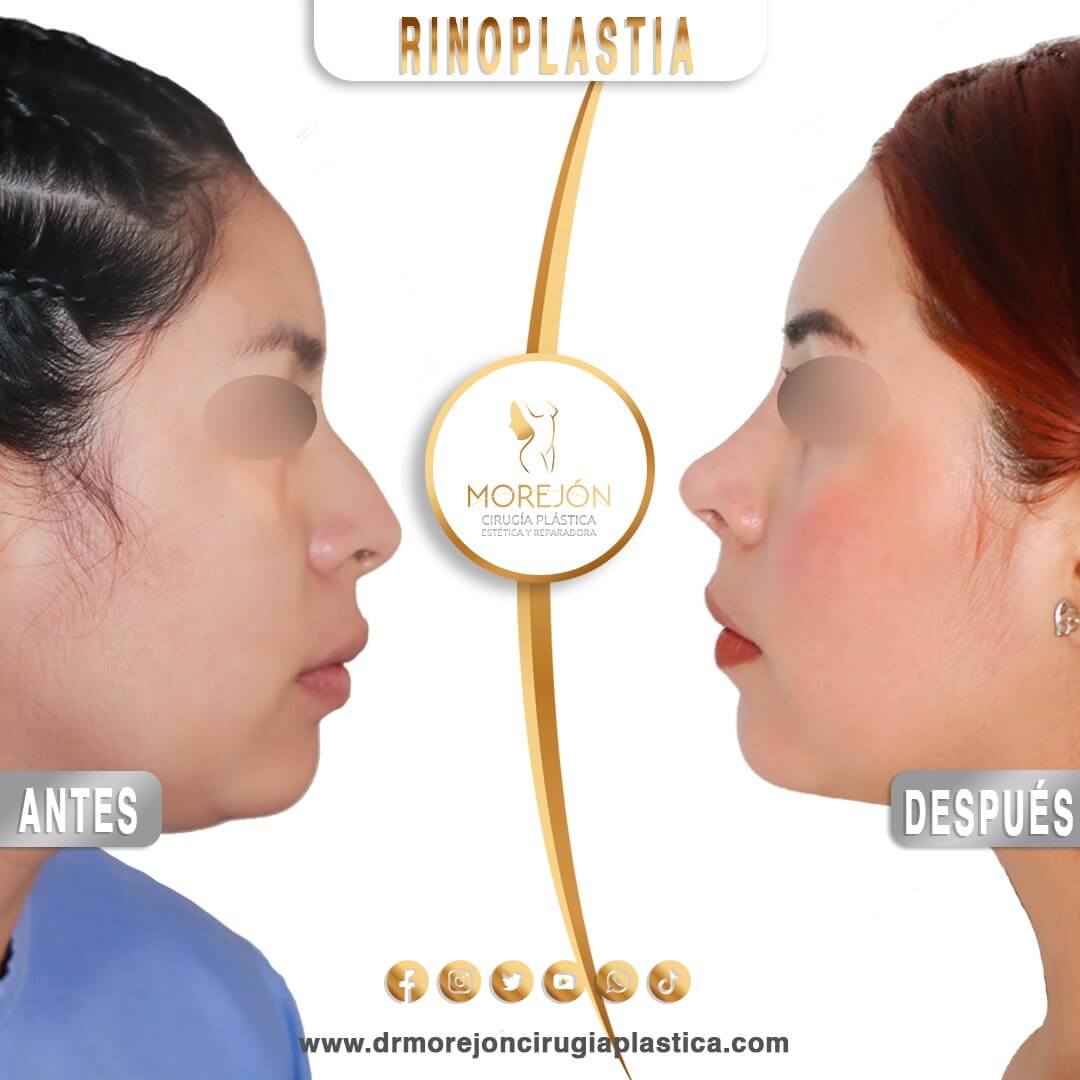 Dr. Diego Armando Morejón Cirujano Plástico Cochabamba