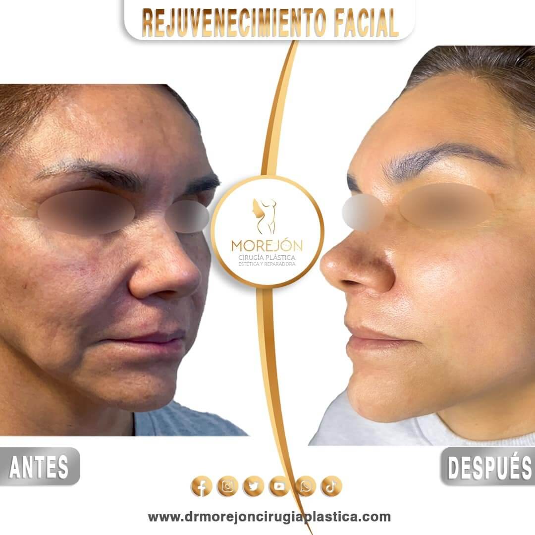 Dr. Diego Armando Morejón Cirujano Plástico Cochabamba