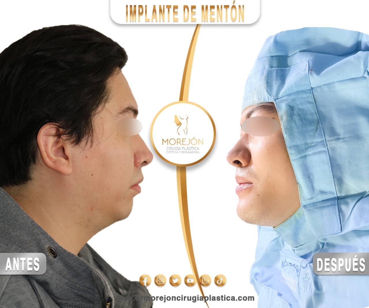 Dr. Diego Armando Morejón Cirujano Plástico Cochabamba