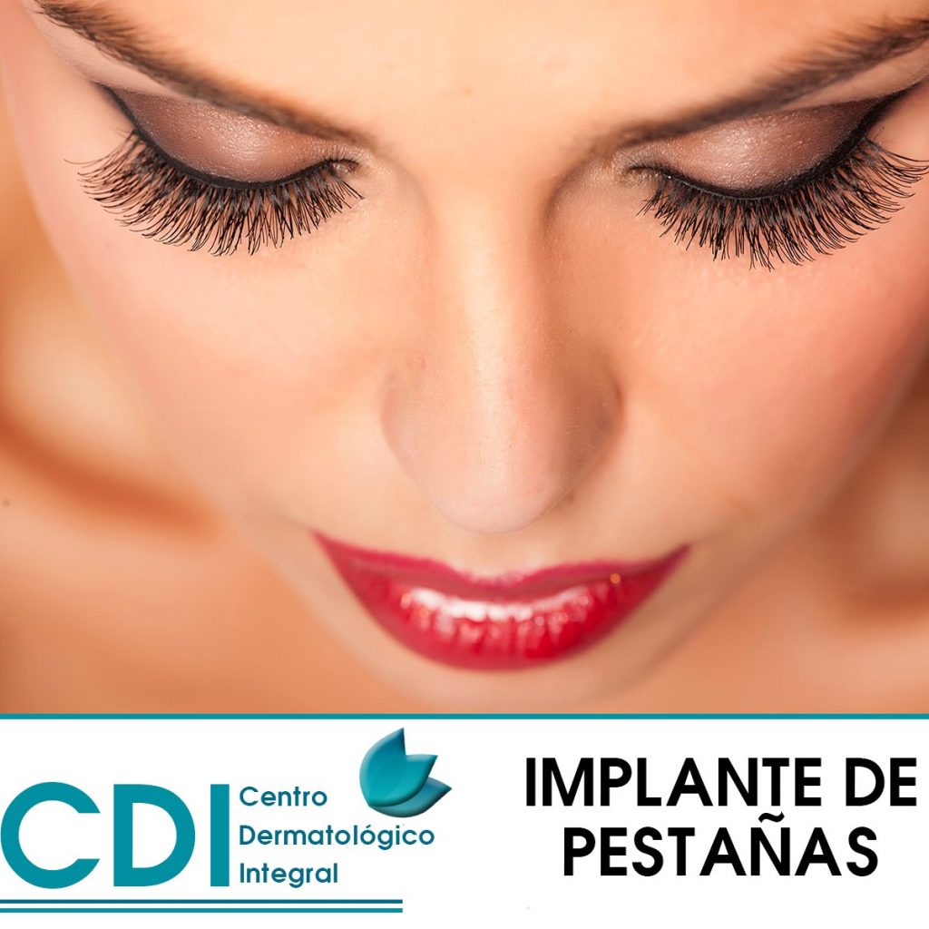 Implante de Pestañas - Dr. Fernando Aguirre - Dermatólogo - Cochabamba