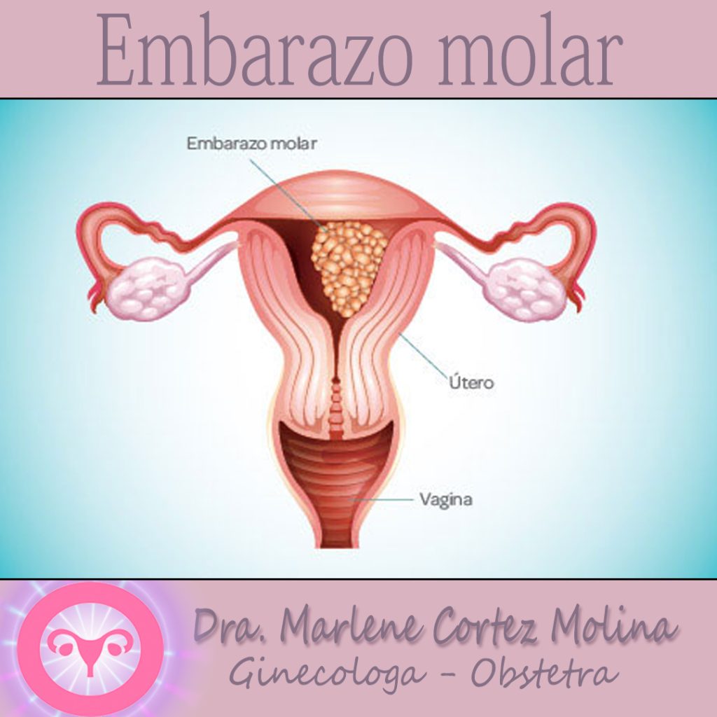 Embarazo Molar - Dra. Marlene Cortez Molina- Ginecólogo - Obstetra - Colposcopía - Histeroscopía - Cochabamba