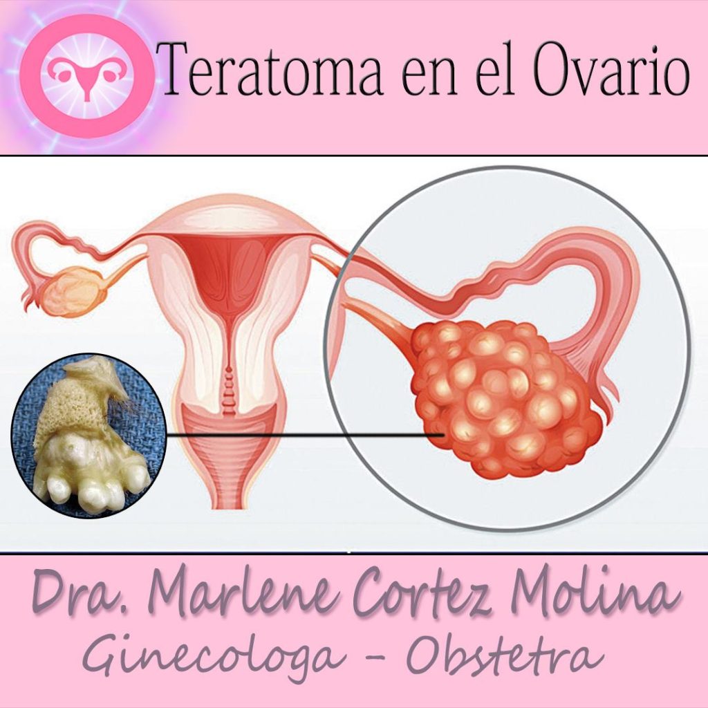 Teratoma de Ovario - Dra. Marlene Cortez Molina- Ginecologo - Cochabamba