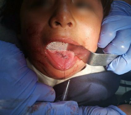 Accidente con Trauma Facial en Niños Cirugía Bucal y Maxilofacial - Centro de Cirugía Bucal y Traumatología Maxilofacial en Bolivia
