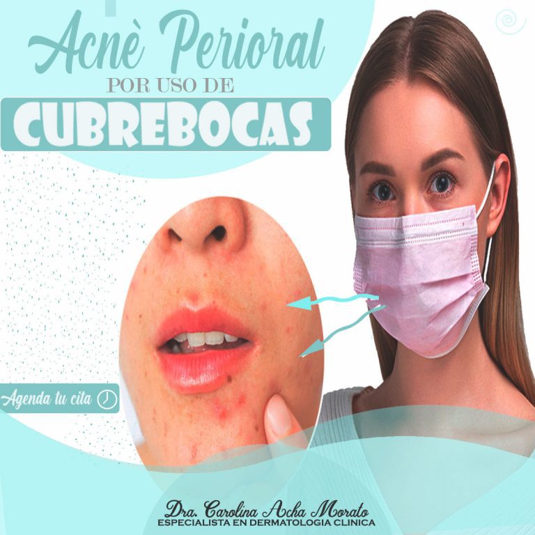 Acne Perioral - Dra. Caroloina Acha Morato Dermatologa Cochabamba