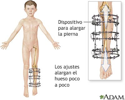 Alargamiento Oseo en Niños y Adultos Dr. Luis Fernando Murillo Zarate Traumatólogo Pediatra La Paz