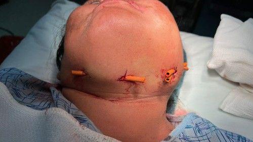 Angina de Ludwig Centro de Cirugía Bucal y Traumatología Maxilofacial en Bolivia