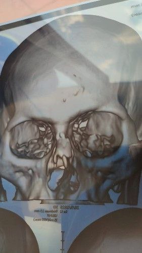 Angina de Ludwig Centro de Cirugía Bucal y Traumatología Maxilofacial en Bolivia