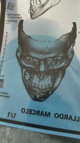 Angina de Ludwig Centro de Cirugía Bucal y Traumatología Maxilofacial en Bolivia