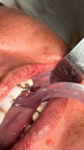 Angina de Ludwig Centro de Cirugía Bucal y Traumatología Maxilofacial en Bolivia