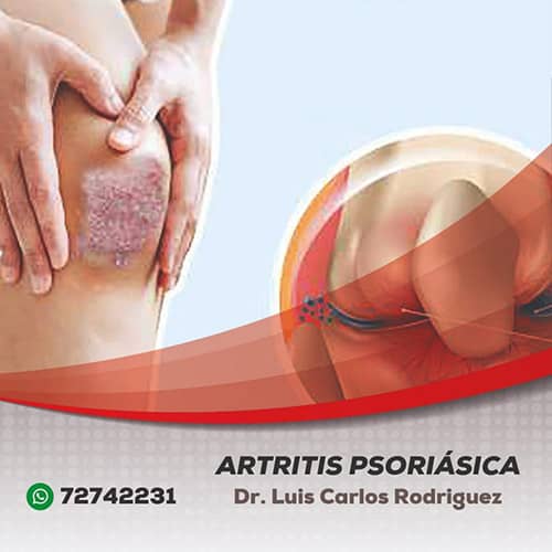 Artritis Psoriasica - Dr. Luis Carlos Rodriguez Delgado – Reumatólogo en Cochabamba