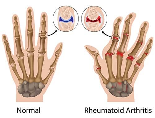 Artritis Reumatoide Dr. Luis Carlos Rodriguez Delgado Reumatólogo Cochabamba