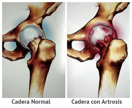 Artrosis de Cadera Dr. Arnold Vergara Montán Traumatólogo Cochabamba