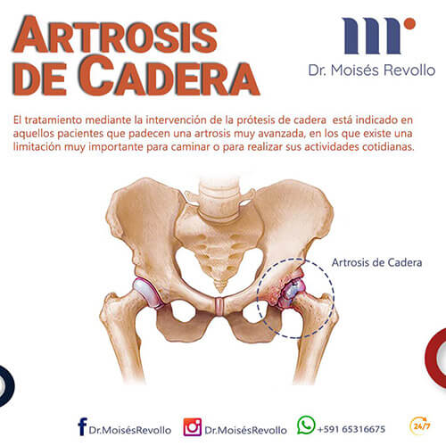 Artrosis de Cadera -Dr. Moises Revollo Traunatologo en Cochabamba