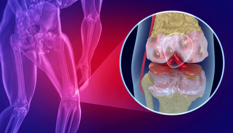 Artrosis de Rodilla Dr. Arnold Vergara Montán Traumatólogo Cochabamba