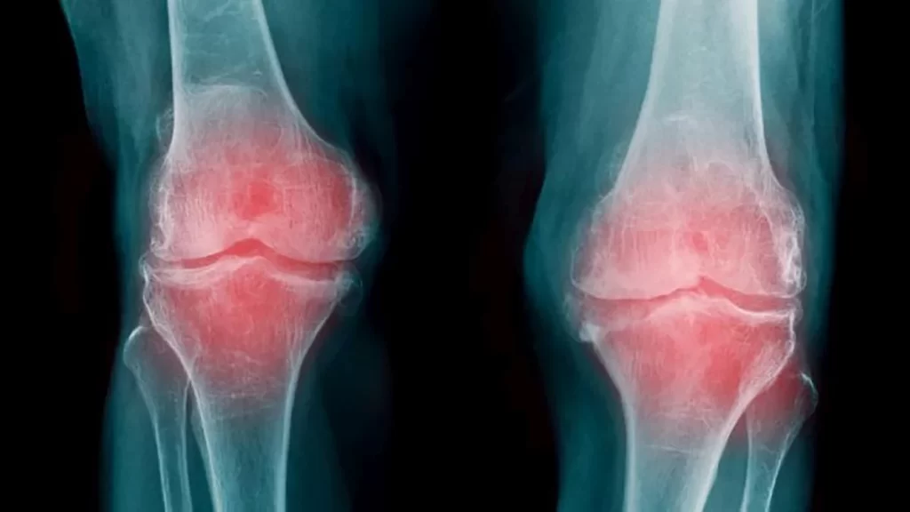 Artrosis de Rodilla Dr. Marcelo Valdivia Loza Traumatologo Cochabamba 1