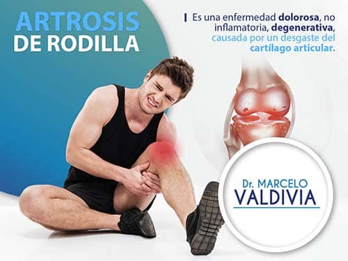Artrosis de Rodilla Dr. Marcelo Valdivia Loza Traumatologo Cochabamba
