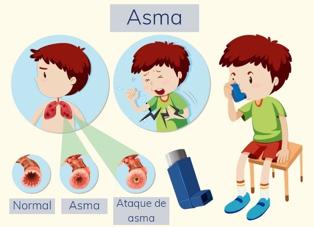 Asma en Niños - Dra. Iveth Gutierrez Guzman Pediatra Cochabamba