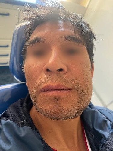 Bolivia Enfrenta una Alta Incidencia de Cáncer Bucal Centro de Cirugía Bucal y Traumatología Maxilofacial en Bolivia