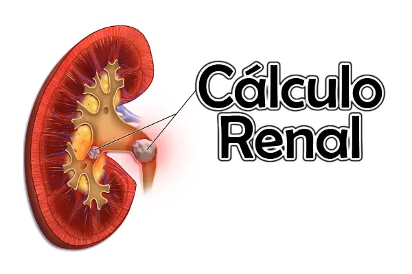 Calculo Renal Dr. Israel Rivas Salazar Nefrólogo Cochabamba-1