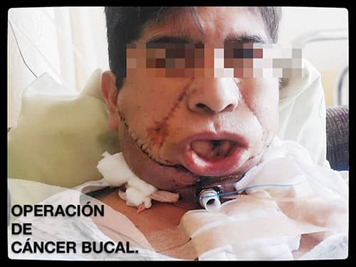 Cáncer Bucal - Centro de Cirugía y traumatología Bucomaxilofacial en cochabamba, La Paz
