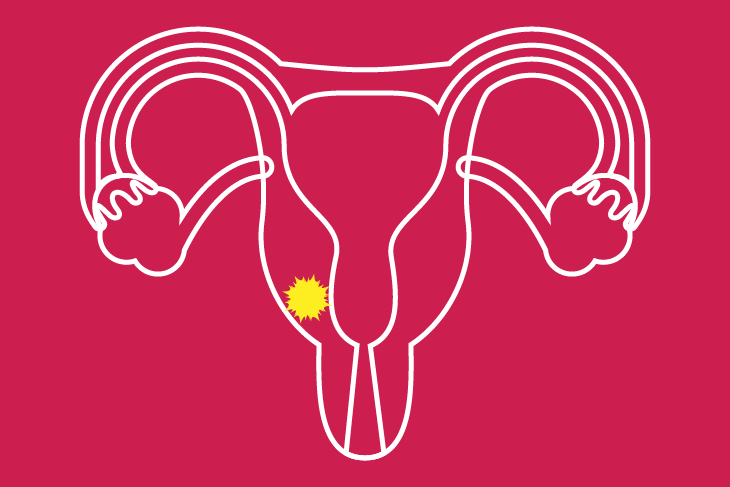 Cancer Cervico Uterino Dr. Juan Abujder Eid Ginecólogo Obstetra Cochabamba 1
