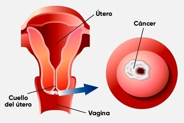 Cancer Cervico Uterino Dr. Juan Abujder Eid Ginecólogo Obstetra Cochabamba