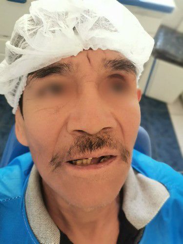 Cáncer Oral Centro de Cirugía Bucal y Traumatología Maxilofacial en Bolivia