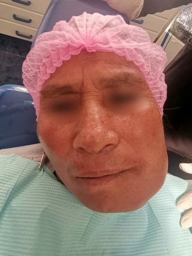 Cáncer de Boca Centro de Cirugía Bucal y Traumatología Maxilofacial en Bolivia
