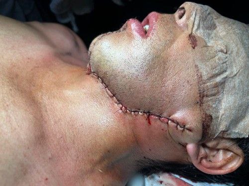 Cáncer de La Cavidad Bucal Centro de Cirugía Bucal y Traumatología Maxilofacial en Bolivia