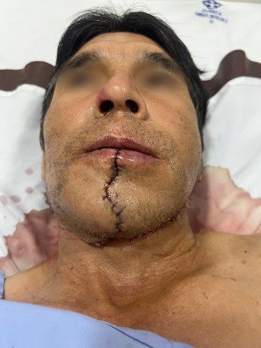 Cáncer de La Cavidad Bucal Centro de Cirugía Bucal y Traumatología Maxilofacial en Bolivia