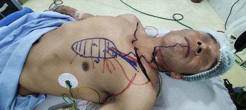 Cáncer de La Cavidad Bucal Centro de Cirugía Bucal y Traumatología Maxilofacial en Bolivia