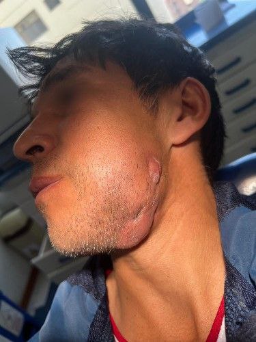 Cáncer de La Cavidad Bucal Centro de Cirugía Bucal y Traumatología Maxilofacial en Bolivia