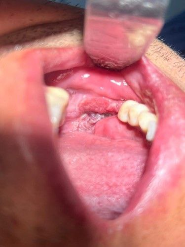 Cáncer de La Cavidad Bucal Centro de Cirugía Bucal y Traumatología Maxilofacial en Bolivia