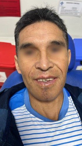 Cáncer de La Cavidad Bucal Centro de Cirugía Bucal y Traumatología Maxilofacial en Bolivia