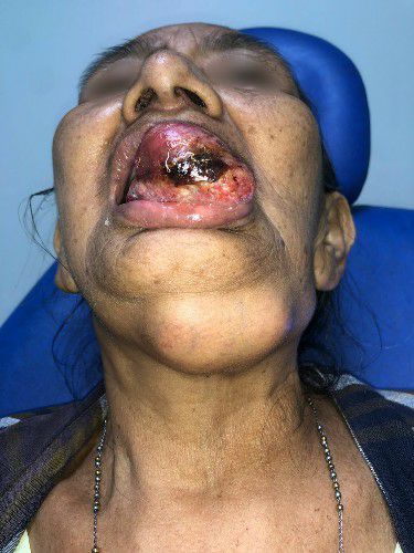 Cáncer de Lengua Centro de Cirugía Bucal y Traumatología Maxilofacial en Bolivia