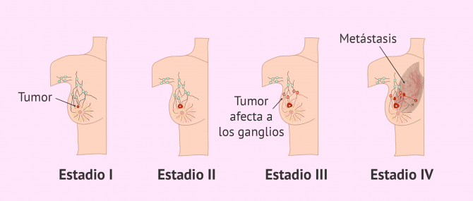 Cancer de Mama Dr. Wilfredo Camacho Oncologo Cochabamba