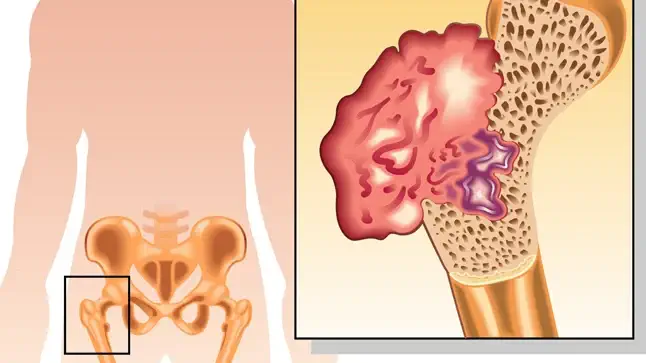 Cancer de Oseo Dr. Wilfredo Camacho Oncologo Cochabamba-1