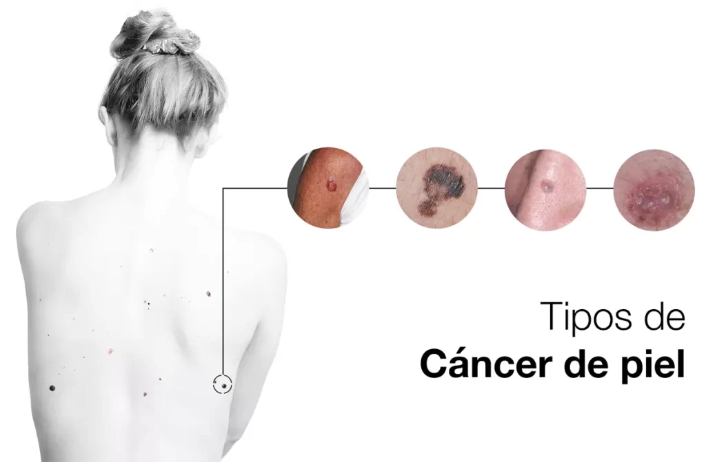 Cancer de Piel Dr. Wilfredo Camacho Oncologo Cochabamba