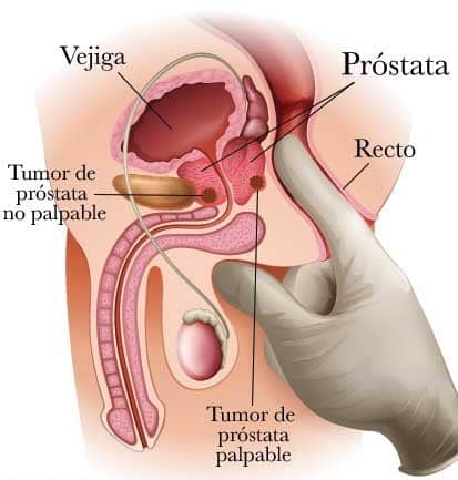 Cáncer de Próstata Dr. Albaro Farfán Chávez Cirujano Urólogo La Paz