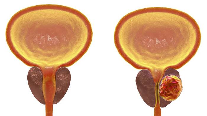 Cancer de Prostata - Dr. Gabriel Valdivia Garron Urologo Cochabamba
