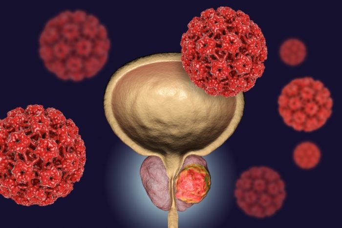 Cancer de Prostata - Dr. Gabriel Valdivia Garron Urologo Cochabamba1