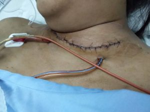 Cáncer de la Glándula Tiroides Centro de Cirugía Bucal y Traumatología Maxilofacial en Bolivia