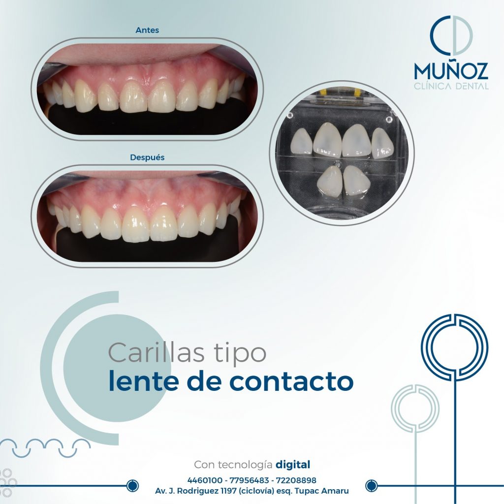 Carillas tipo Lente de contacto - Clínica Dental Muñoz - Cochabamba