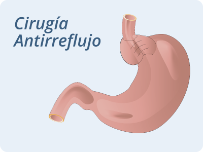 Cirugía Antirreflujo Dr. Yuri Gil Sabja Cirujano General y Laparoscopia Cochabamba