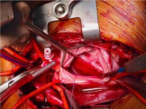 Cirugía Cardiaca Congénita Dr. Carlos Brockmann Cirujano Cardiovascular en Bolivia