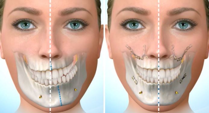 Cirugía Ortognática Centro de Cirugía Bucal y Traumatología Maxilofacial en Bolivia