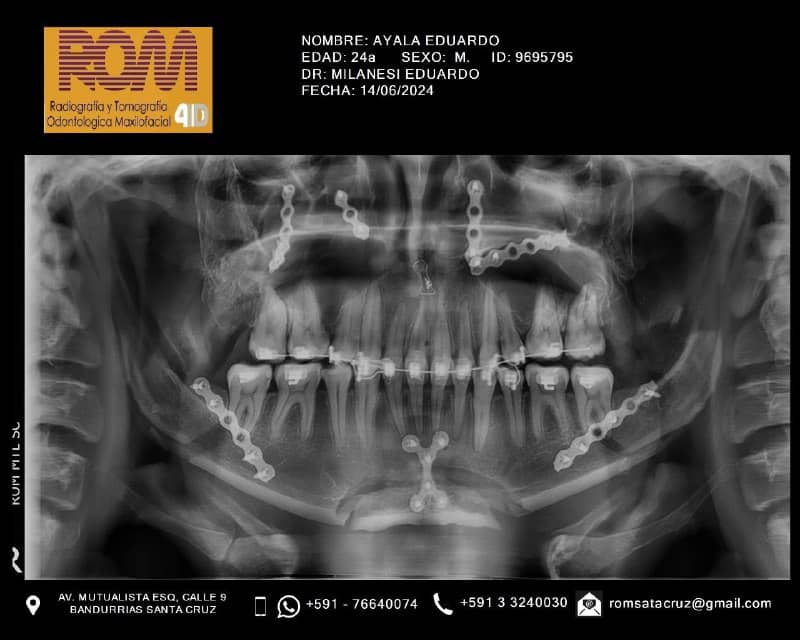 Cirugía Ortognática de Quijada o Mentón Centro de Cirugía y Traumatología Bucomaxilofacial Bolivia