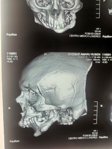 Cirugía Ortognática y Reconstructiva de la Mandíbula Centro de Cirugía Bucal y Traumatología Maxilofacial en Bolivia