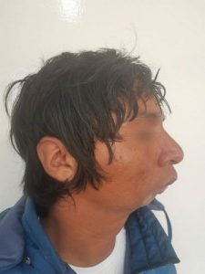 Cirugía Ortognática y Reconstructiva de la Mandíbula Centro de Cirugía Bucal y Traumatología Maxilofacial en Bolivia