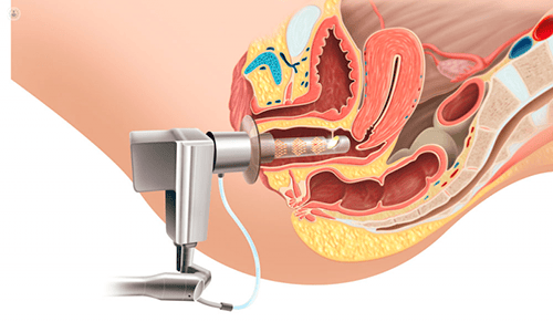 Cirugía Transvaginal Dr. Javier Ferrufino Iriarte Urólogo Cochabamba